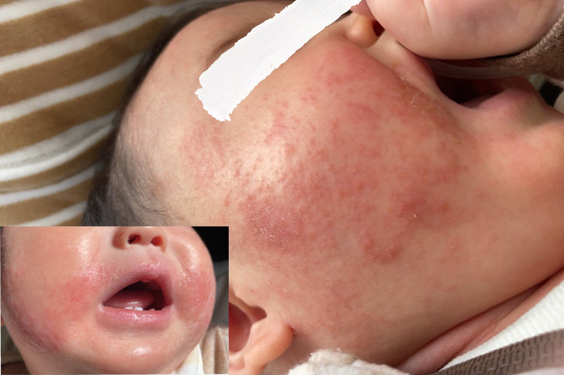 “For anyone determined to seriously improve their atopic dermatitis.”